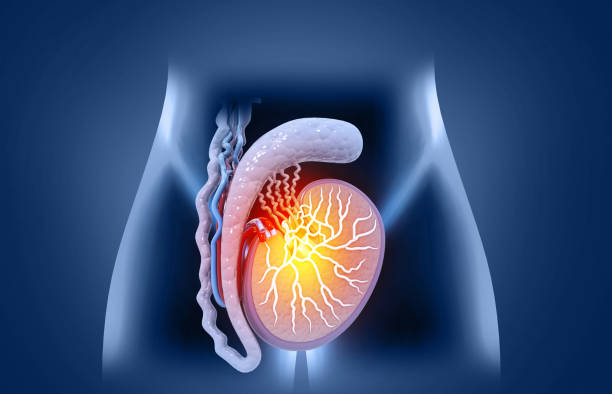 Dalili za Korodani Kuvimba: Ishara 11 kwa Mwanaume, Sababu na Tiba