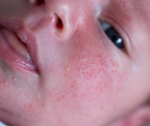 Dalili Za Fangasi Za Mdomoni Kwa Watoto: Sababu Na Tiba Haraka