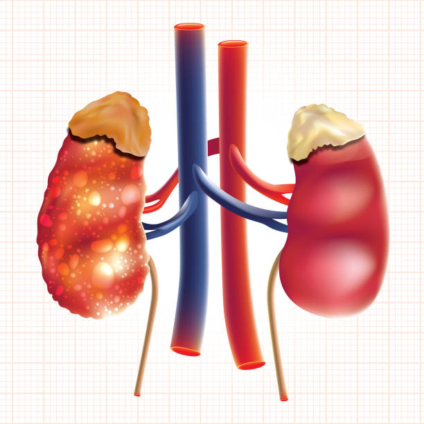 Dalili Za Figo Kufeli: Sababu, Madhara Na Jinsi Ya Kutibu Haraka