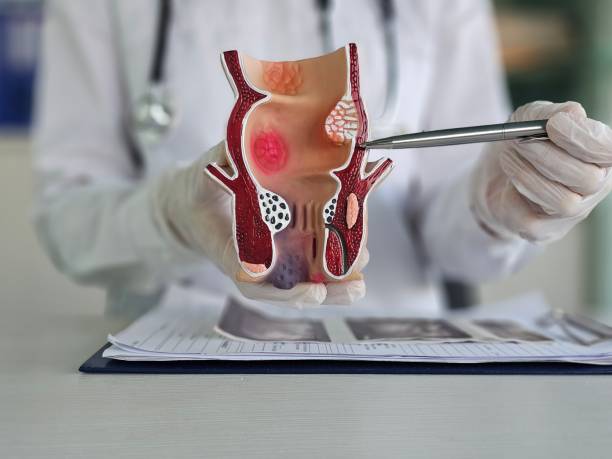 Dalili Za Fistula: Sababu, Madhara Na Jinsi Ya Kutibu Haraka