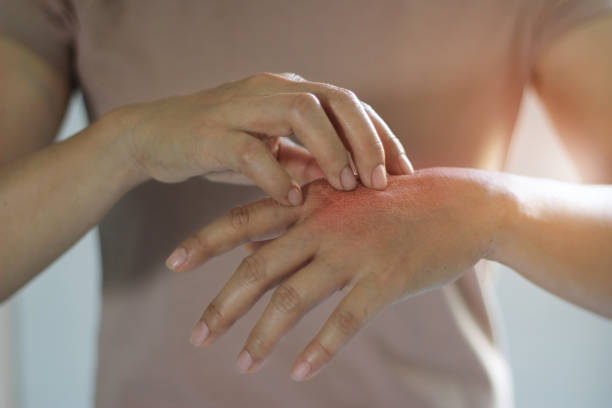 Allergy ya Ngozi: Ishara, Sababu, Kinga na Tiba ya Mzio wa Ngozi