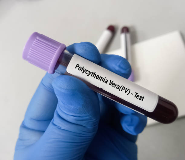 Dalili za Damu Kuzidi Mwilini (Polycythemia): Ishara, Sababu na Tiba
