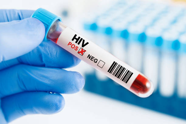 Dalili za Ukimwi: Ishara za HIV, Matibabu na Kinga Muhimu